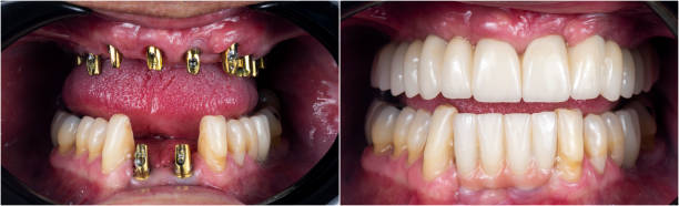 before and after pictur of full jaw dental recovery by implants and ceramic crowns