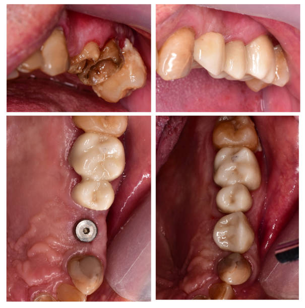 teeth treatment with zirkon crowns and implant